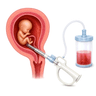 abortion