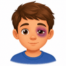 Black eye