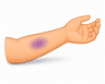 bruise