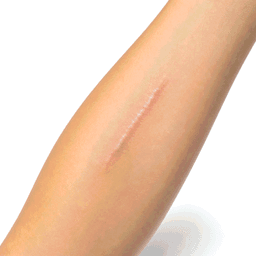 scar