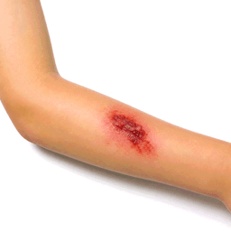 wound