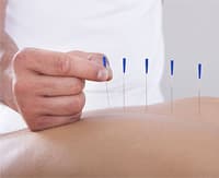 acupuncture