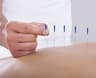 acupuncture