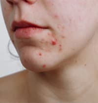 pimple