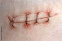 surgical staple